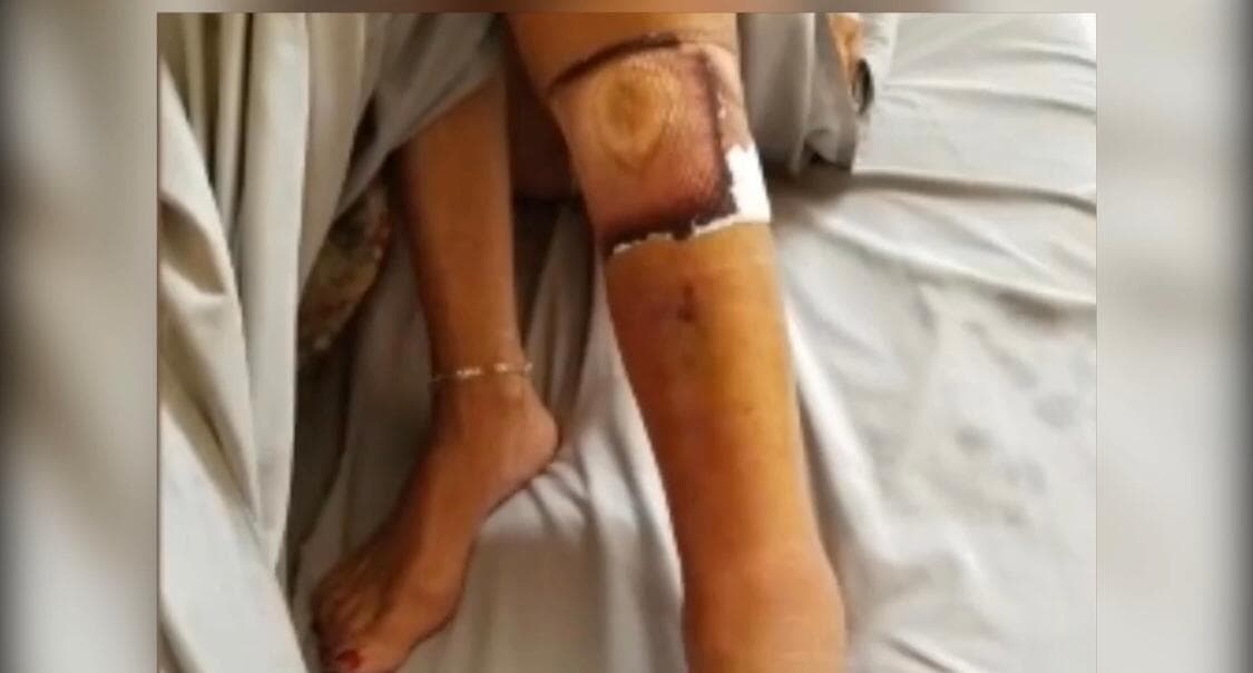“Le quitaron toda la piel hasta los dedos de los pies”: hijo de mujer fallecida por bacteria “come carne”