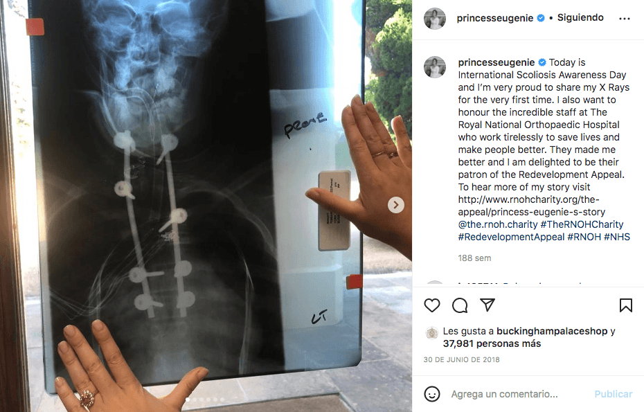 La cirugía incluyó la inserción de varillas de 8 pulgadas y tornillos en su columna vertebral y cuello, los cuales la princesa mostró en una radiografía.