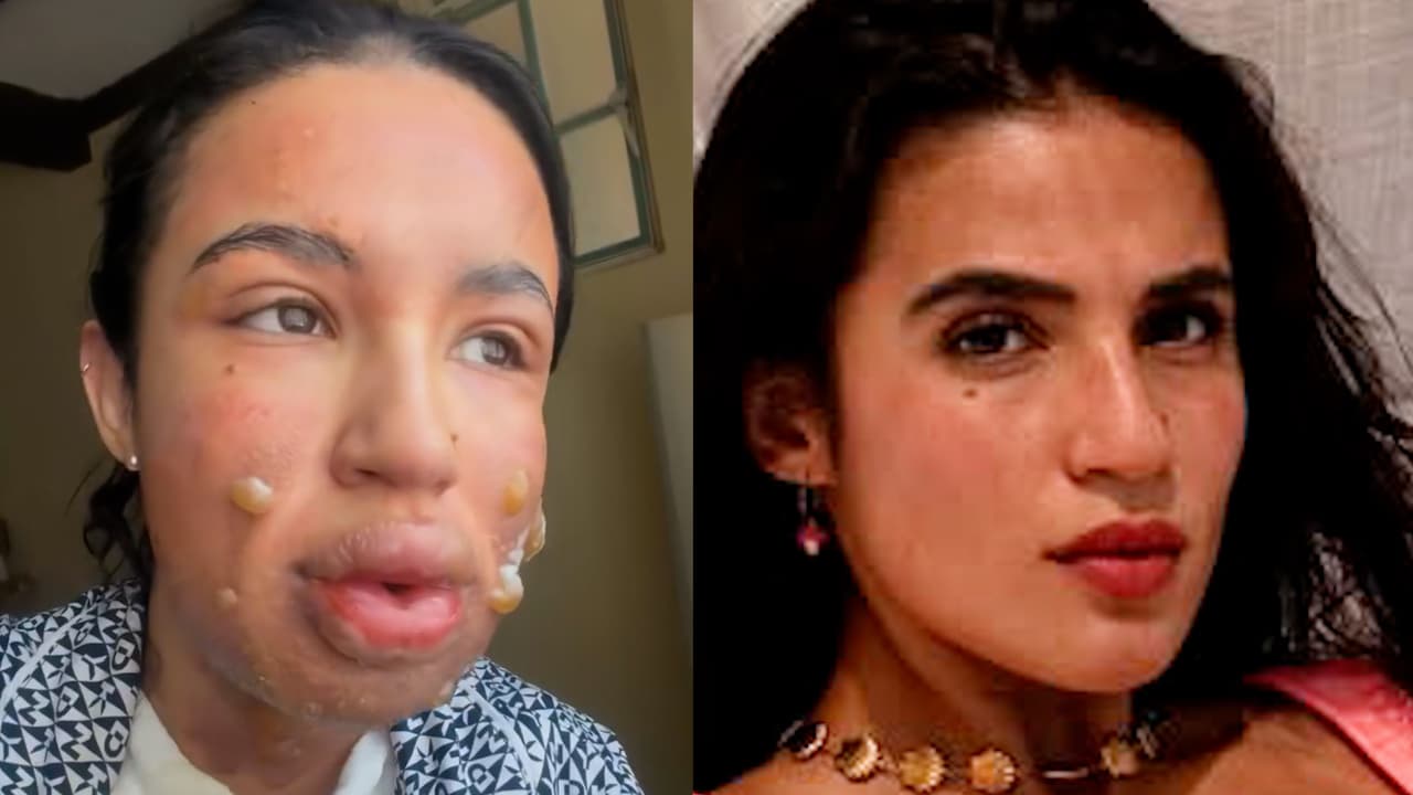 Actriz mexicana sufre quemaduras tras explosión en su apartamento: así va su recuperación