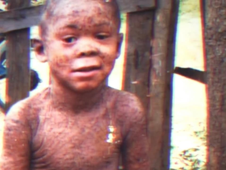 Cuando su pequeño Henry nació, Santa Tejada supo que algo no estaba bien porque sus ojitos estaban salidos de arriba y abajo, además de que no se le veían dedos, sino como una especie de bolsas de agua en sus extremidades. 
<br>