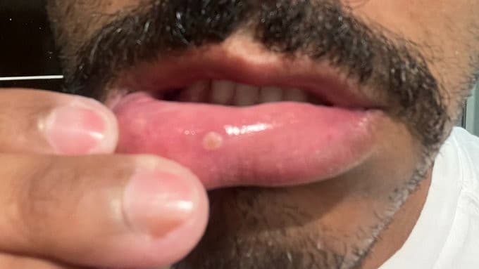 Homem descobre que afta era, na verdade, varíola dos macacos e relato viraliza: há como diferenciar