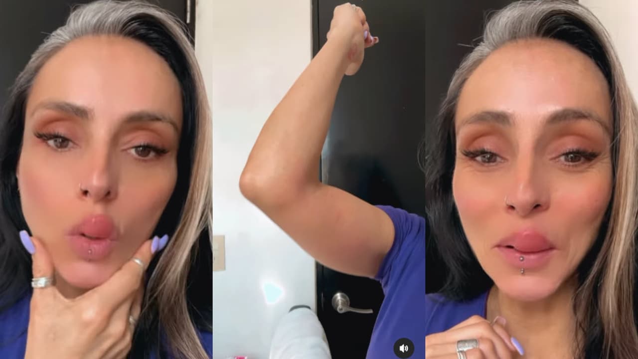 Ivonne Montero también mostró la picadura que sufrió en uno de sus brazos.