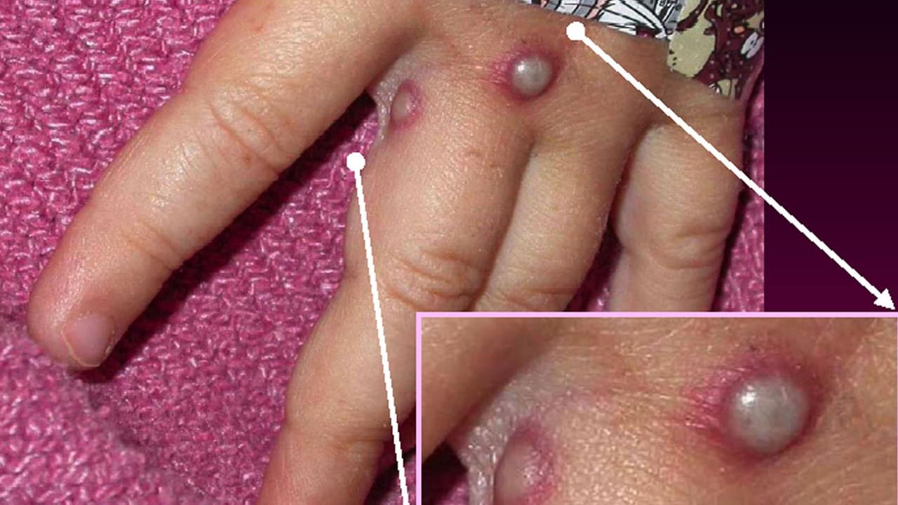 Biden dice que hay suficientes vacunas para la viruela del mono: por qué esta enfermedad no es como el covid-19