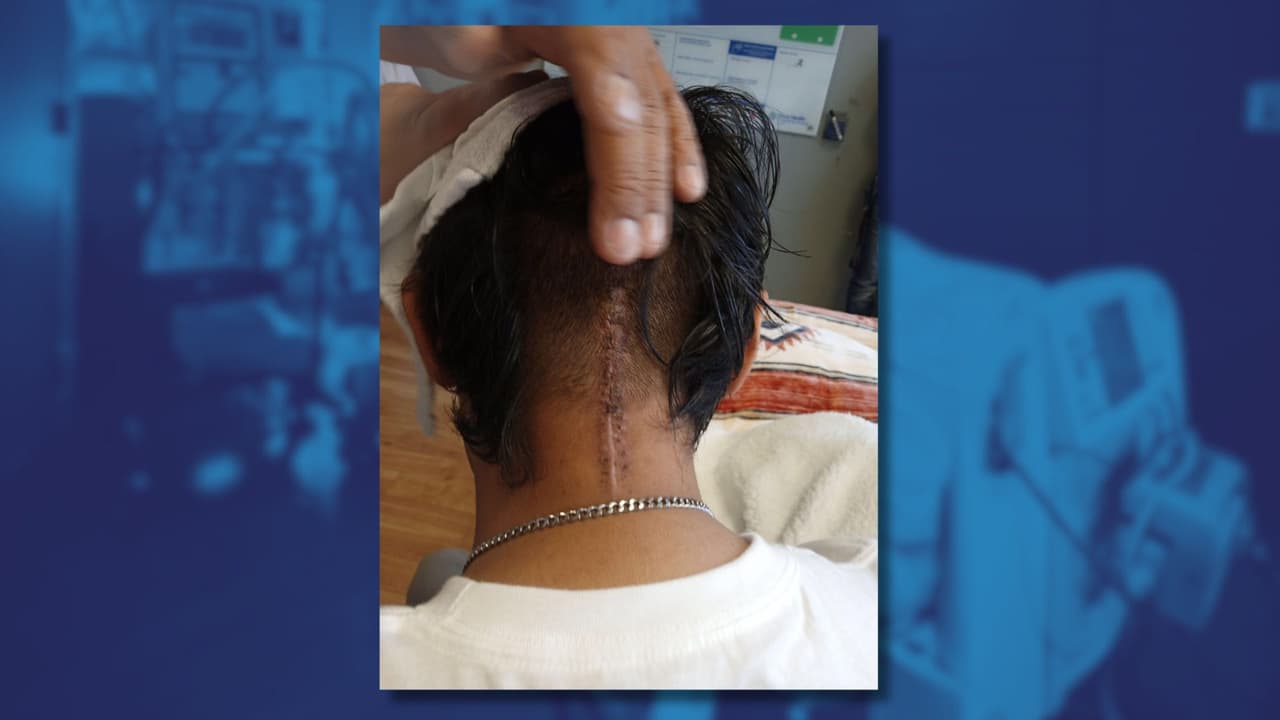 Gael Gómez muestra la cicatriz detrás de su cuello tras ser operado de emergencia debido a un derrame cerebral.