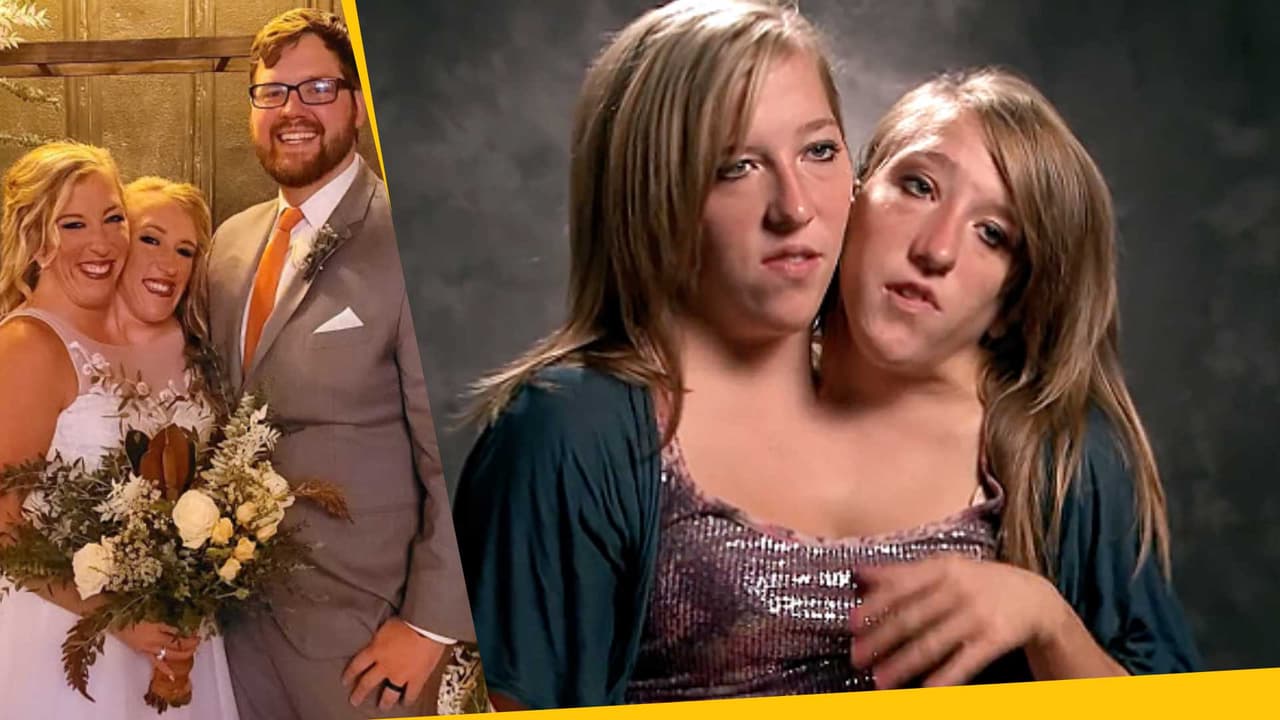 Gemela siamesa se casa y genera curiosidad en Internet: la historia de Abby y Brittany Hensel