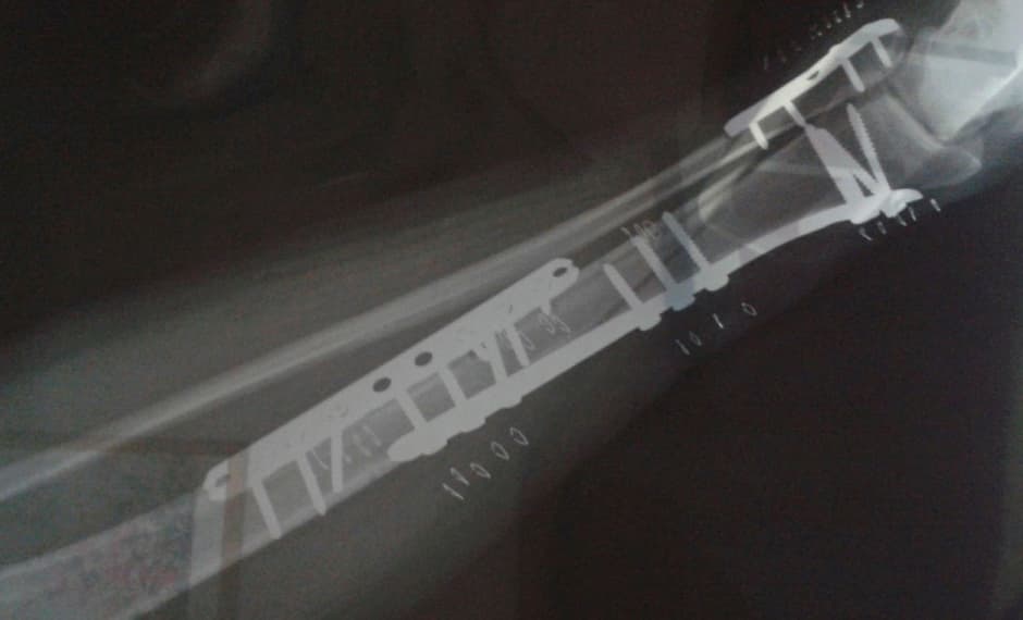 La radiografía después la operación, con todo y tornillos y placas metálicas.