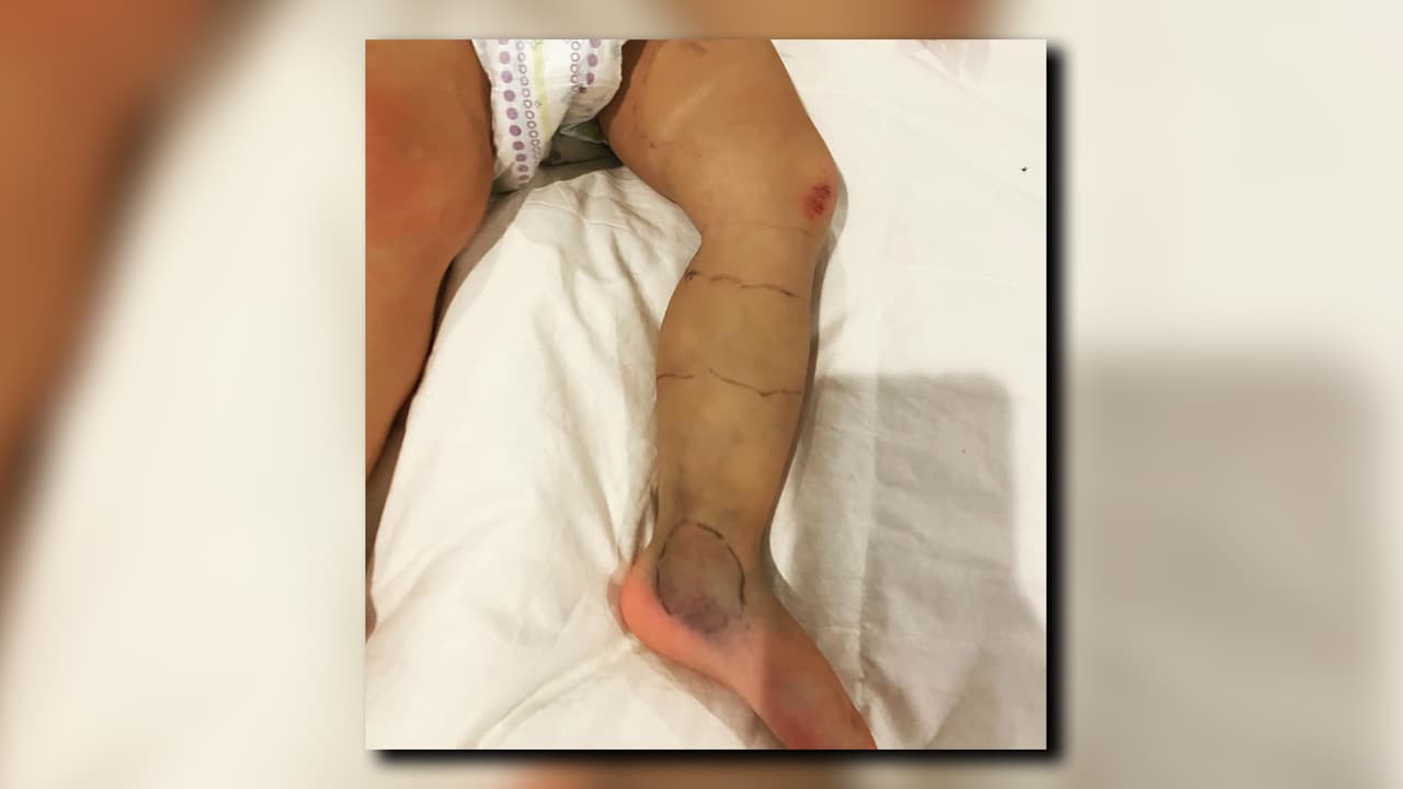 La bebé afortunadamente se está recuperando, aunque la familia dice que aún tiene secuelas de la mordida.