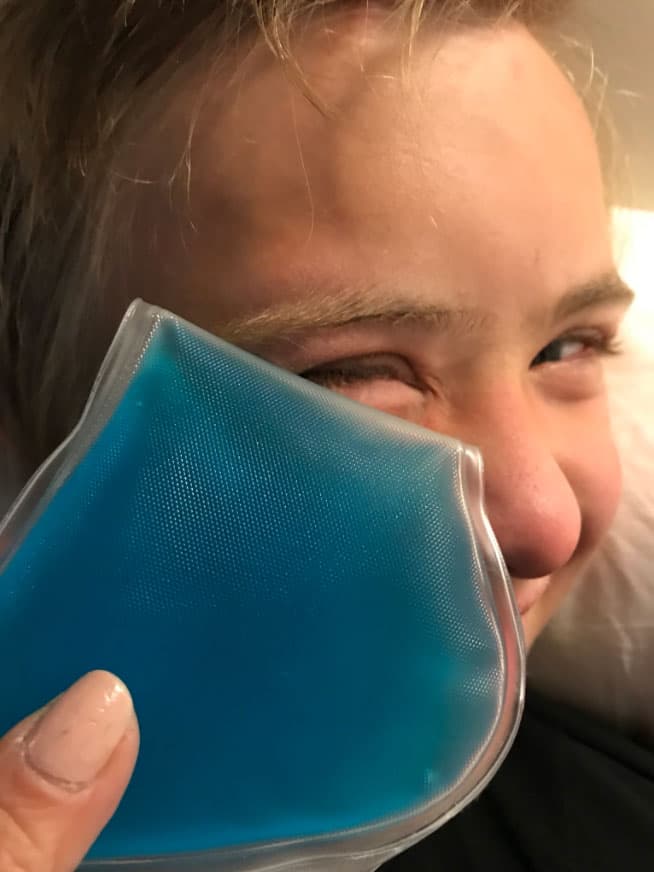 Calderón le puso una bolsa de gel fría para desinflamar la zona del golpe.