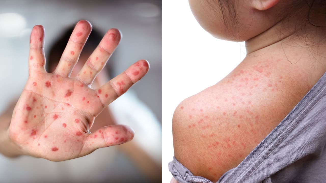 Brote de sarampión en Texas: ¿cómo proteger a tu familia? Esto dice una experta