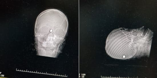 These X-rays are of a victim who died at 3 o'clock in the morning in El Bautista hospital in Managua. The accuracy of the fatal bullet indicates the shooter most likely was trained.
