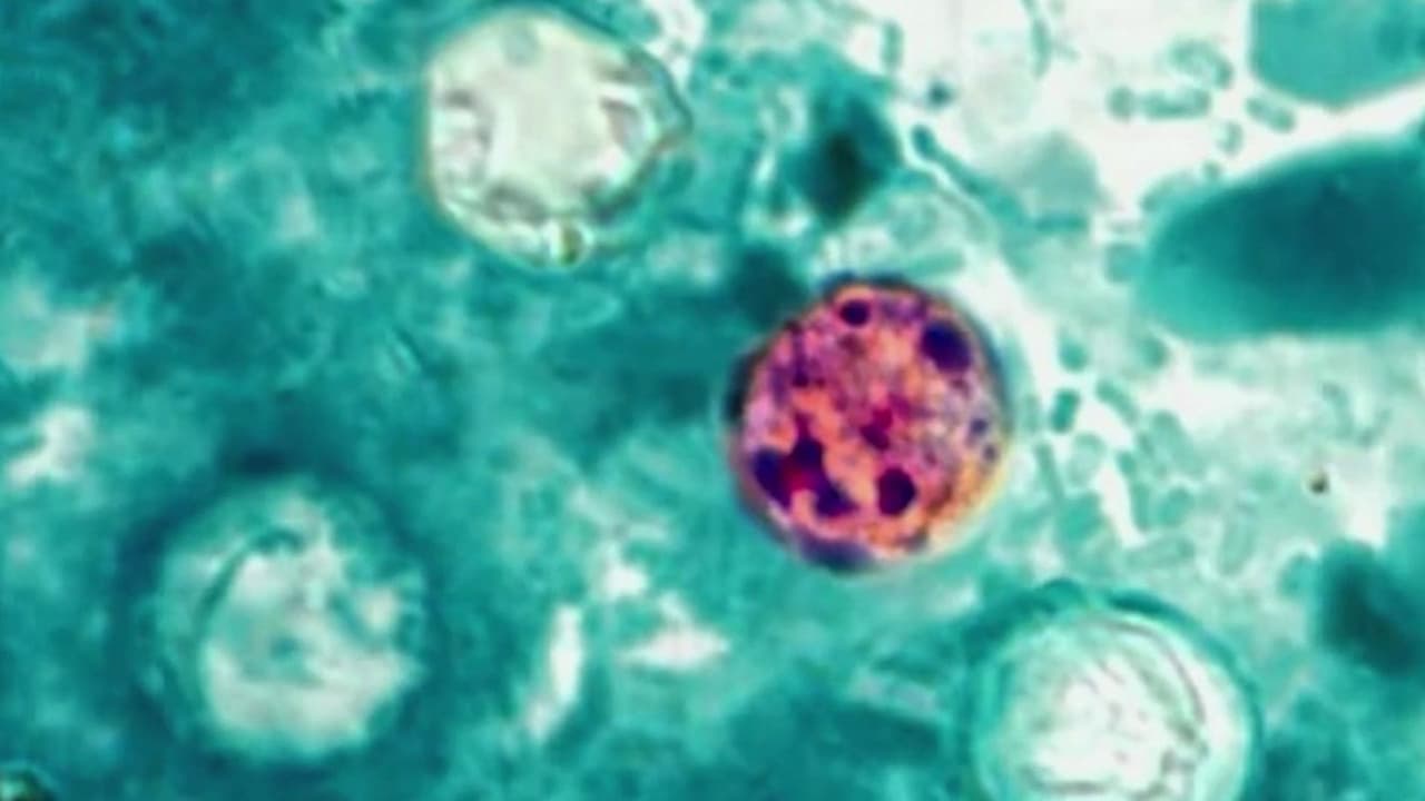 Brote de ciclosporiasis abre nuevo frente judicial: Pareja presenta demanda contra dos compañías