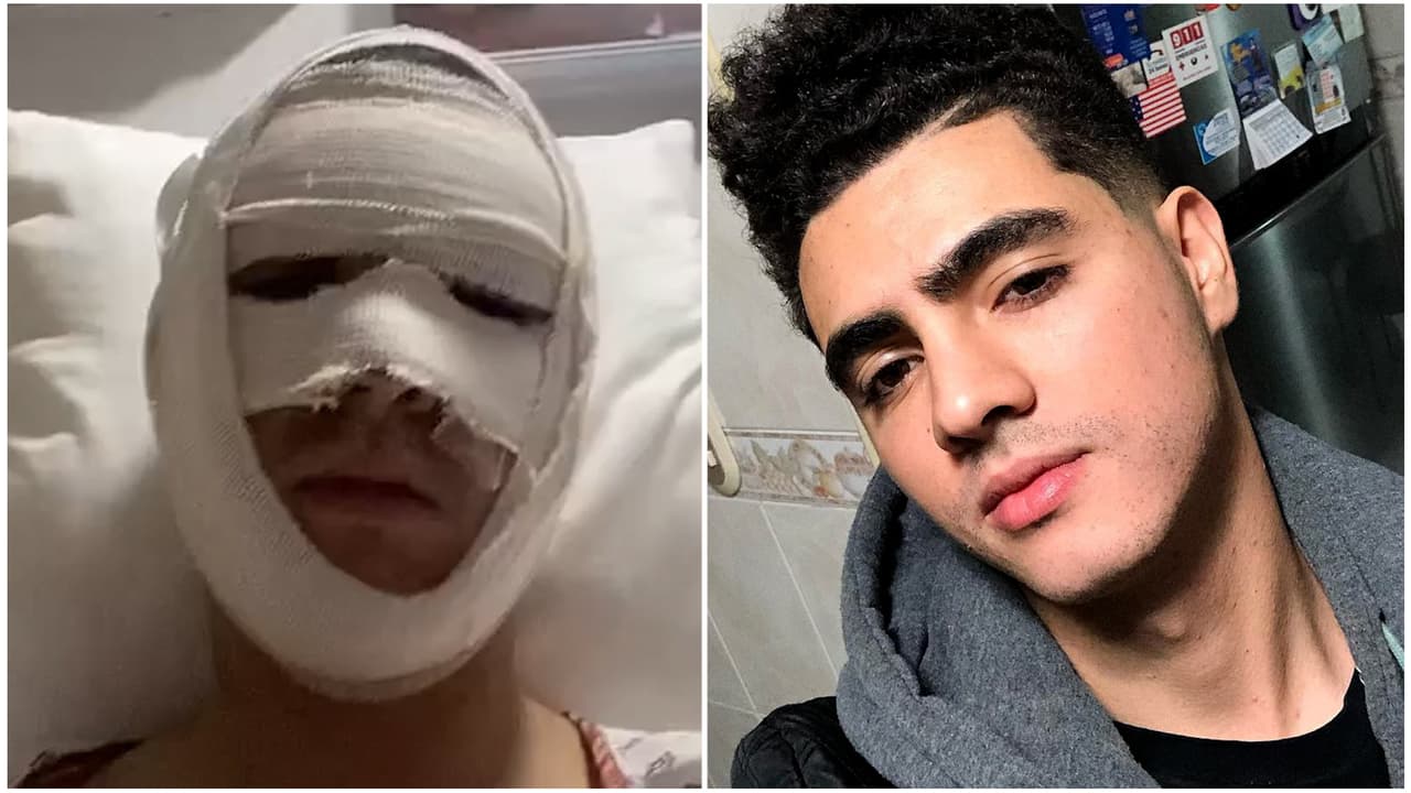 Así quedó Omar Yubeili, actor de Mi Corazón Es Tuyo, después de sufrir quemaduras en el rostro