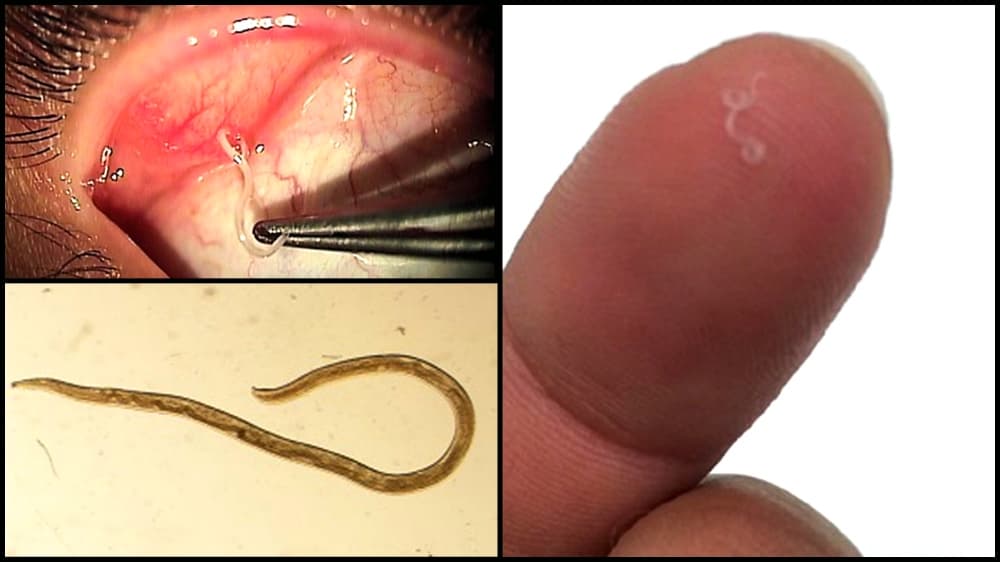 Abby Beckley sacó con su dedo uno de los 14 gusanos que tenía en el ojo izquierdo.