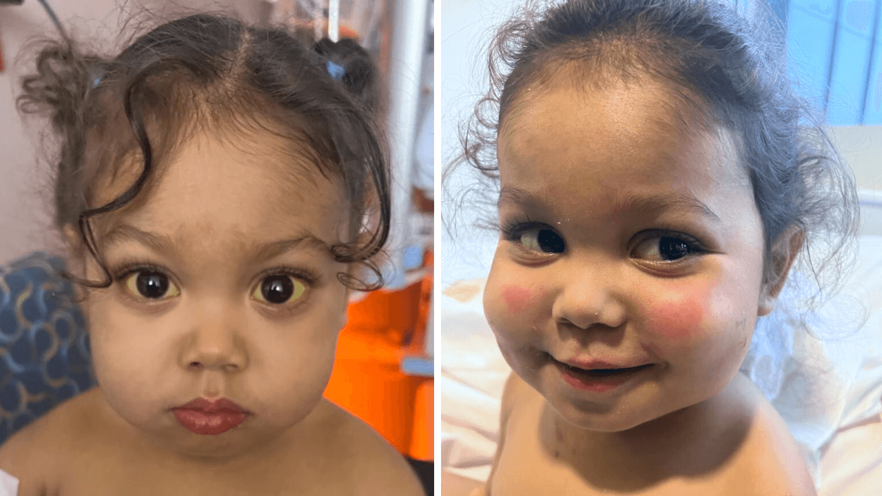 Logra sobrevivir: la pequeña Kawailani estuvo a punto de morir, pero recibe el trasplante de hígado que necesitaba