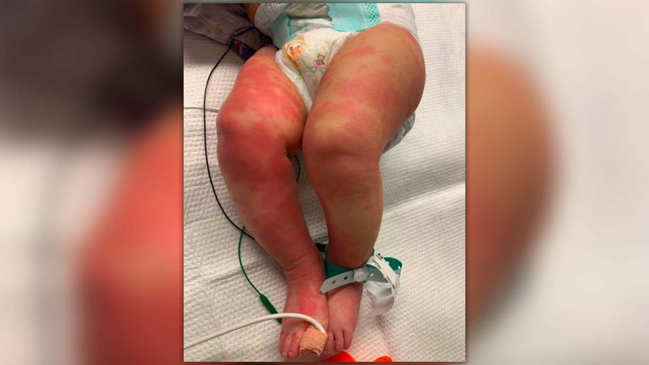 Los expertos consultados por Noticias 23 dicen que la enfermedad es rara, pero existen tratamientos efectivos y detectarla a tiempo podría prevenir su severidad e incluso la muerte. Si sus hijos presentan estos síntomas, debe llamar de inmediato a su pediatra. 
<br>