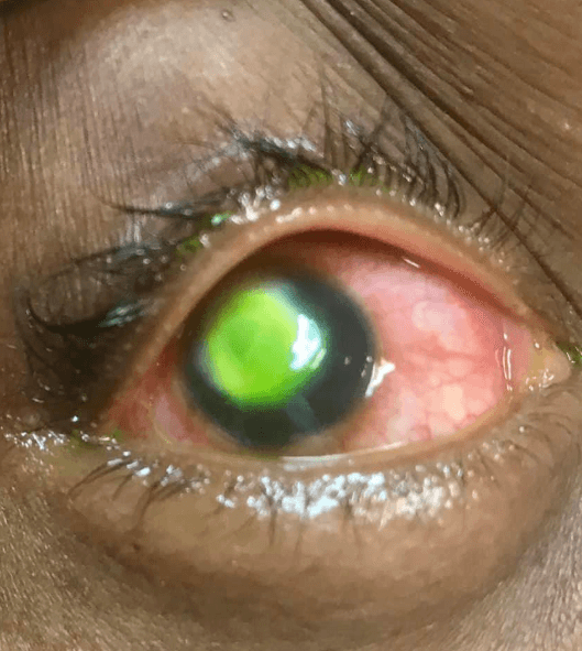 Dormir con cualquier tipo de lentes de contactos aumenta entre seis a ocho veces el riesgo de contraer un tipo grave de infección de la córnea, aclara el doctor.