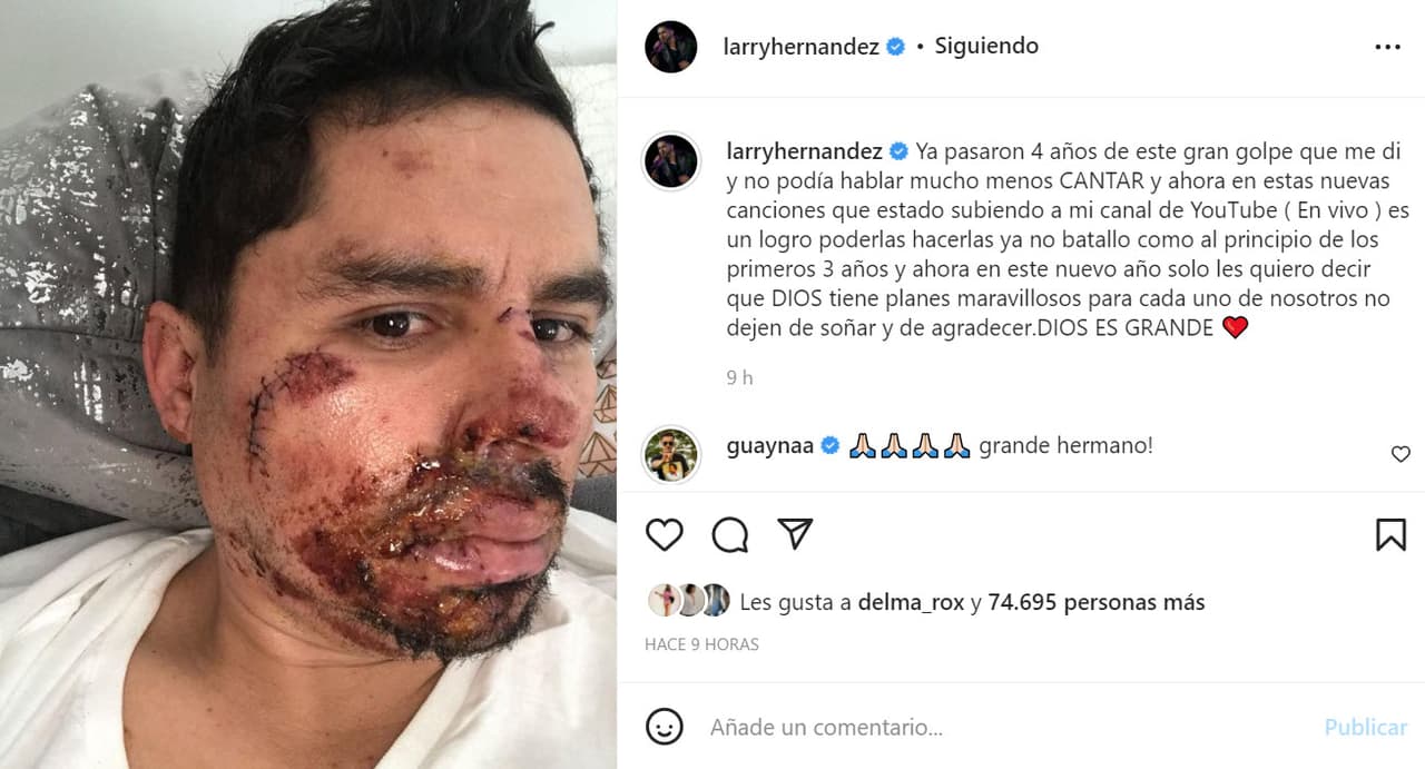 "Ya pasaron 
<b><a href="https://www.univision.com/entretenimiento/lento-pero-seguro-larry-hernandez-comparte-en-redes-su-recuperacion" target="_blank">4 años de este gran golpe que me dí</a></b>", escribió en el inicio de su mensaje junto a esta foto que muestra las lesiones que sufrió. 
<br>