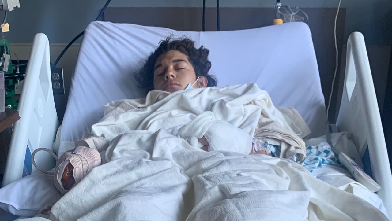 Piden ayuda para joven de 17 años que pierde una mano al estallarle fuego artificial