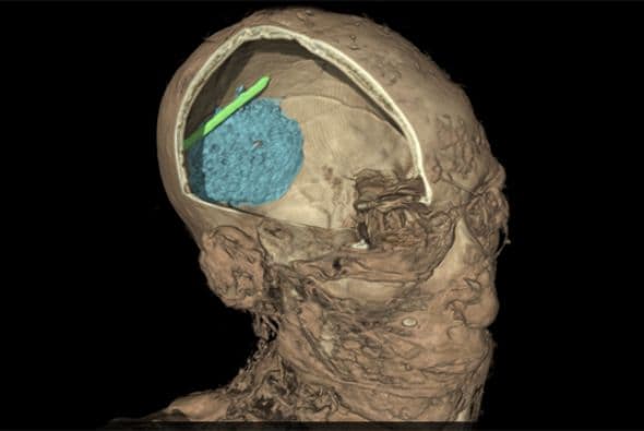Esta imagen muestra la calavera de un hombre adulto momificado cuyo nombre se desconoce. El escáner revela que una espátula se quedó dentro del cráneo del individuo durante el proceso de embalsamado. (Crédito: British Museum)