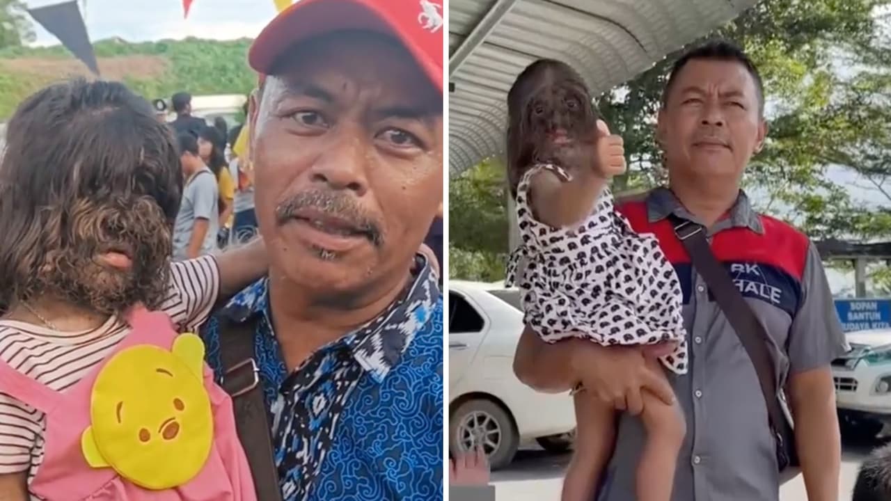 Niña con ‘síndrome de hombre lobo’ conmueve a Internet: esta es su increíble historia 