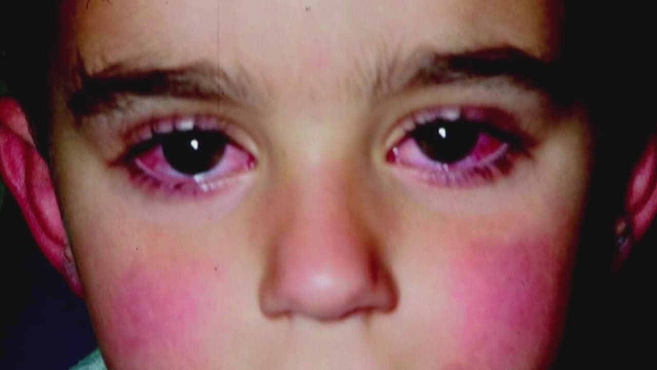 "Lidiamos con algo nuevo": expertos en California advierten sobre el síndrome en niños que relacionan con el coronavirus