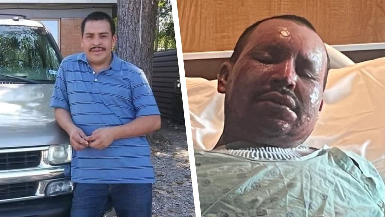 Francisco Escobar de 34 años, sufrió quemaduras de segundo grado y perdió u hogar y todas sus pertenencias en la explosión.