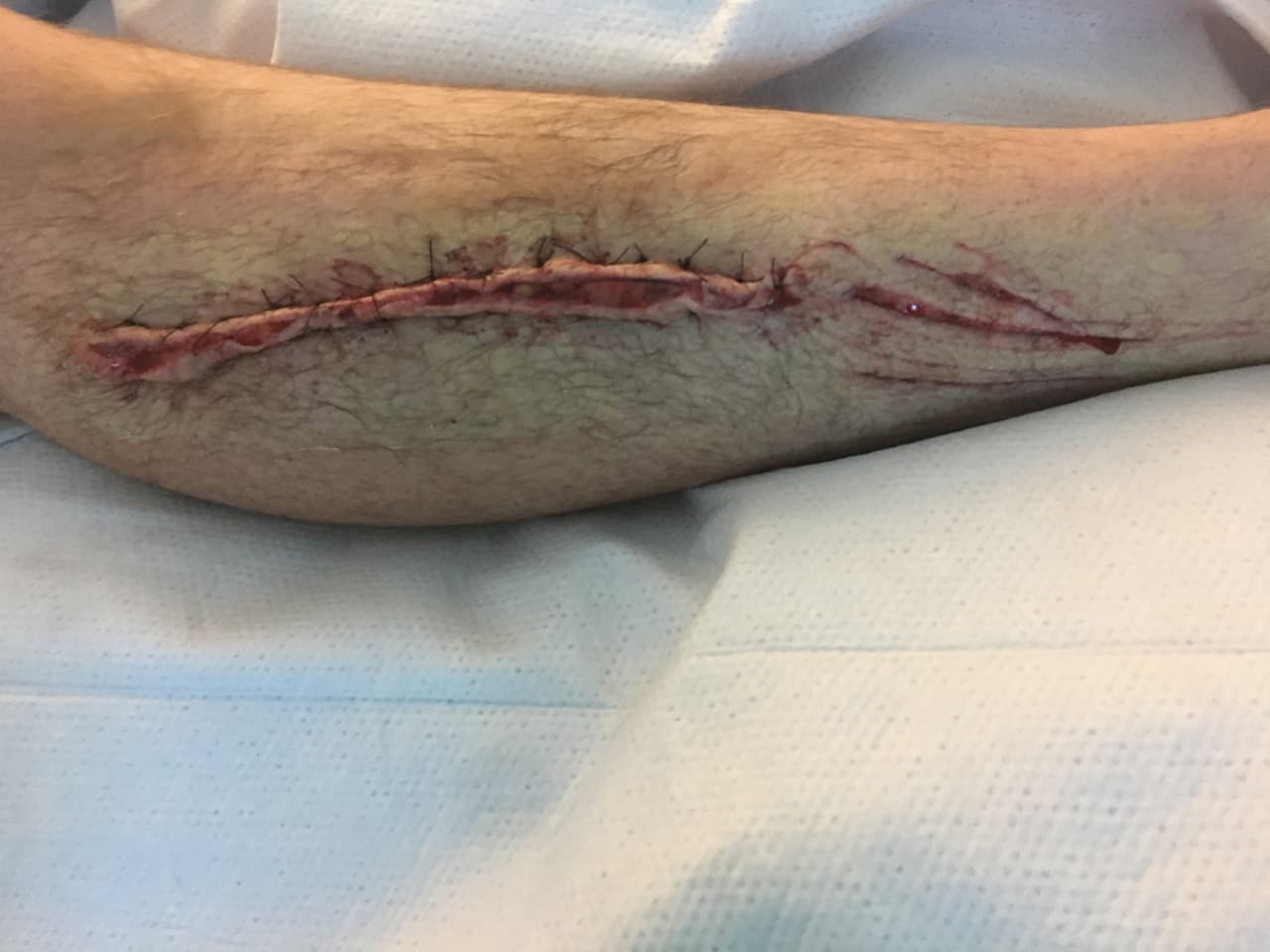 Allí, Bowden tuvo que ser sometido a una cirugía, porque el tiburón punta negra que lo atacó, le había arrancado un pedazo de músculo. 
<br>