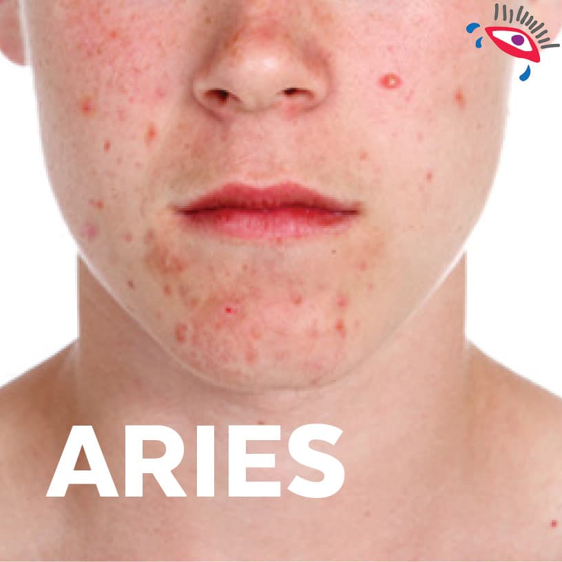 Te saldrán muchos granos en la cara.