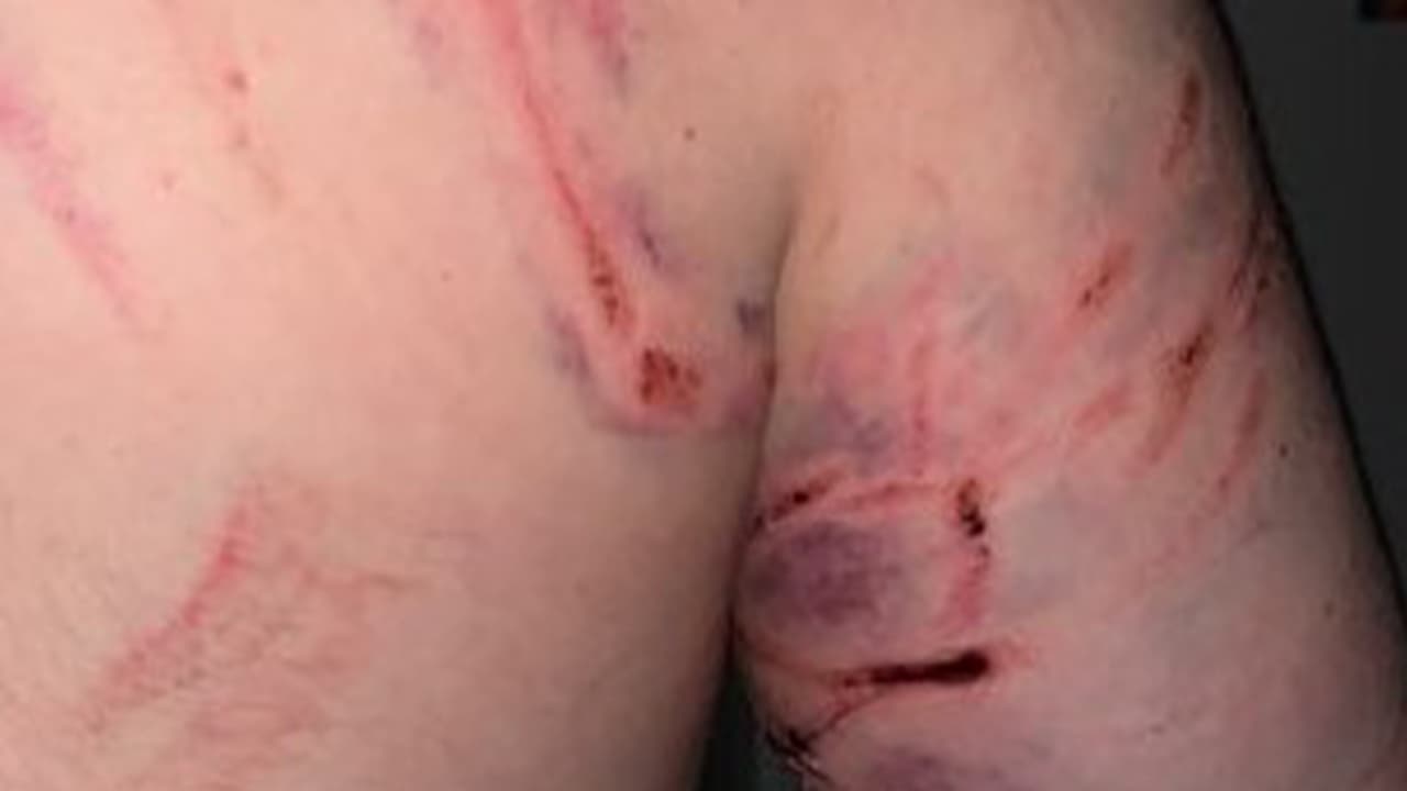 Benfer denuncia que sufrió varias heridas, entre ellas, una que medía 4 pulgadas de largo.