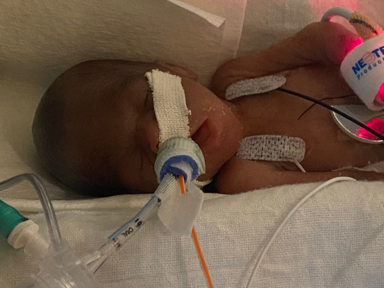 Curtis estuvo conectado a un ventilador por tres meses y después de meses adicionales de cuidados las 24 horas, pudo irse a casa en abril pasado. Este niño de 
<a href="https://www.univision.com/temas/alabama">Alabama</a> ahora ha sido certificado como el bebé más prematuro del mundo en sobrevivir.