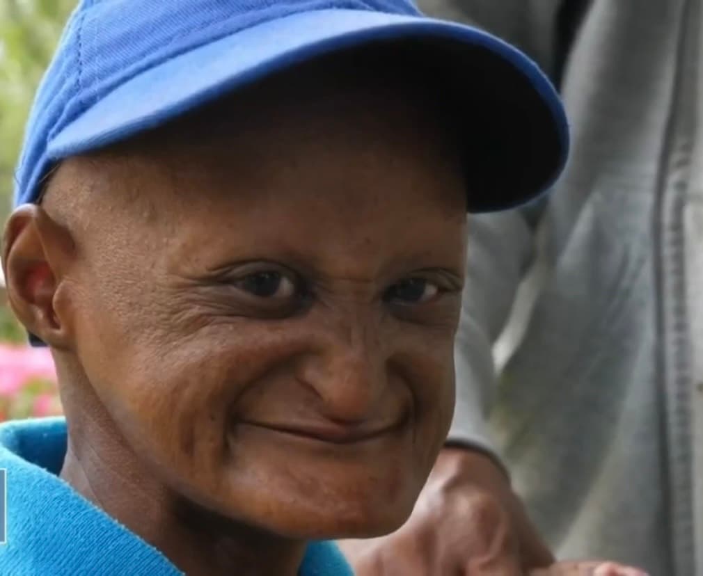 Walmeli, mejor conocido como Misael, es el tercero de cuatro hermanos y si bien nació sin ningún tipo de complicaciones, el lento desarrollo que presentó a los dos años de edad alertó a los médicos de un hospital, 
<b>quienes dictaminaron tajantemente que su problema no tenía solución. </b>
<br>
<br>