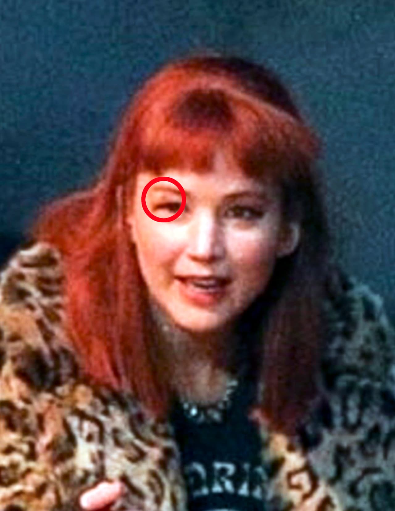 En esta imagen es posible ver la ulceración que dejó el accidente en el rostro de la actriz.