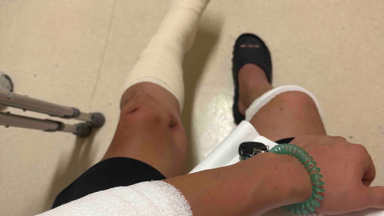 Sufrió una fractura de pierna y necesita cirugía.