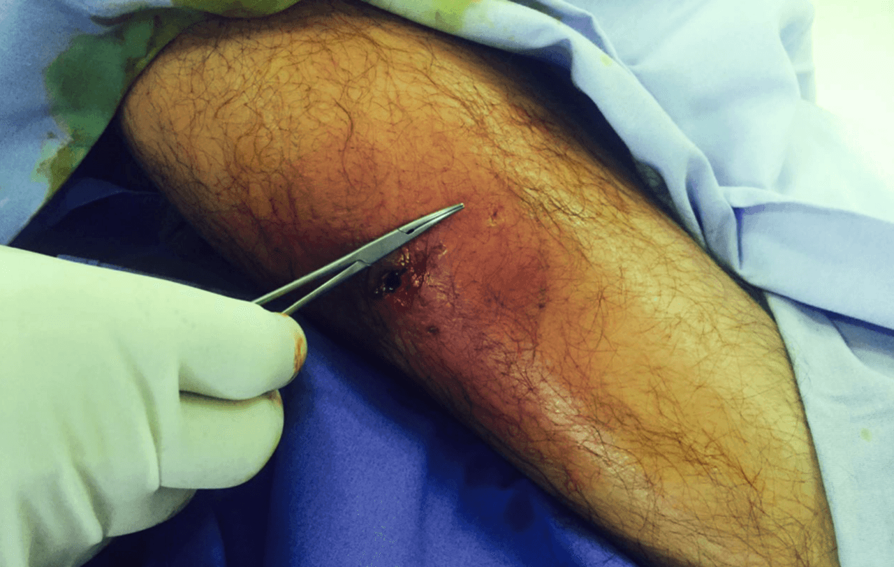 A Fernández le extirparon el tejido dañado, pero en muchos casos se debe amputar el miembro para controlar el avance de la infección.