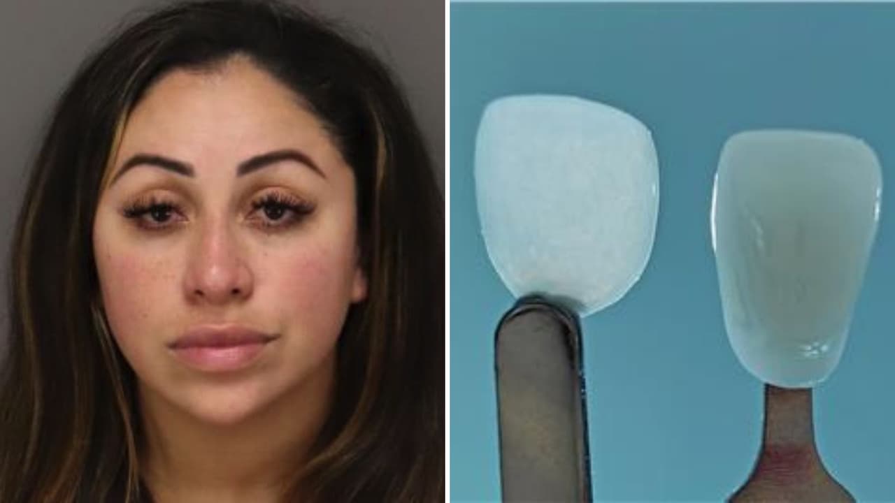 Falsa dentista provoca cirugía de emergencia tras colocar carillas con pegamento de uñas