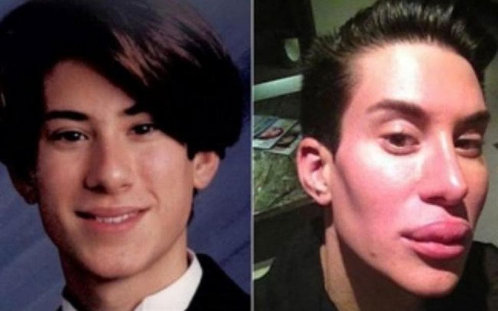 El neoyorkino de 37 años, se ha realizado 90 operaciones para parecerse a Ken, el novio de la Barbie. Su obsesión por conseguir el ideal de belleza masculino le ha llevado a gastarse más de 100 mil dólares en cirugía estética. Y esto no acaba aquí. Tal y como ha confesado el Ken humano, no piensa detenerse en su carrera por seguir ‘mejorando´ su apariencia, publicó el ‘Huffington Post’.