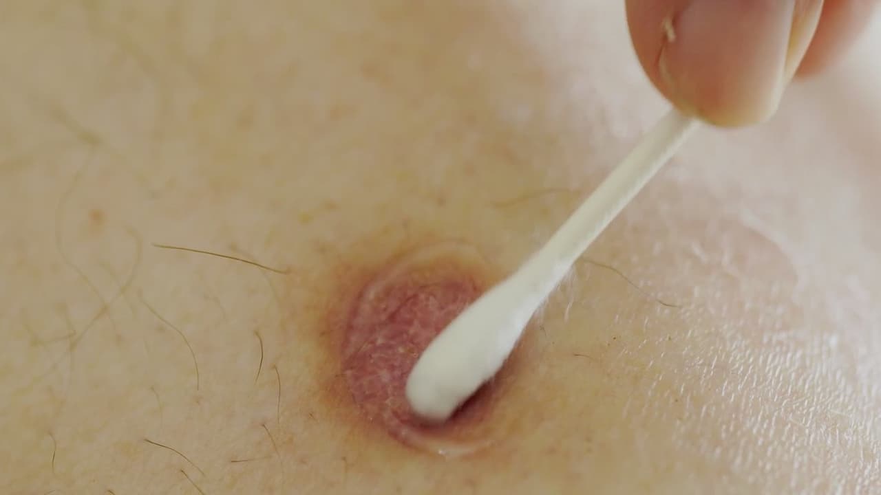 Cáncer de piel: conoce algunos síntomas y señales de alerta, así como medidas de prevención