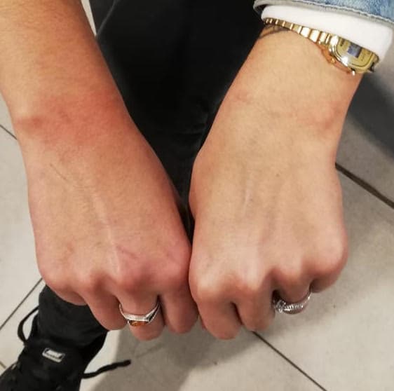 Alicia muestra las lesiones en sus muñecas después de ser esposada.