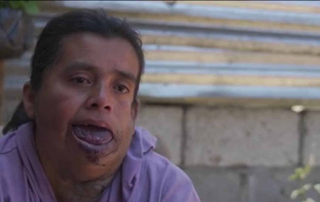 Herminia Hernández siempre soñó con enamorarse de alguien que viera la entereza y las ganas de salir adelante que siempre ha tenido y no la malformación de su lengua. Un día conoció a quien creía que podía ser el amor de su vida,
<b> hasta que le confesó que le daba asco verla. </b>
<br>