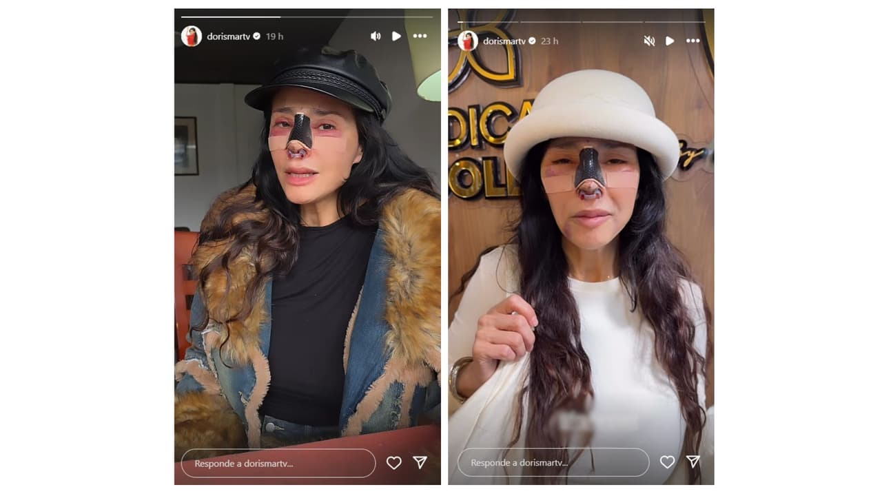 Dorismar vive pesadilla tras cirugía de nariz.