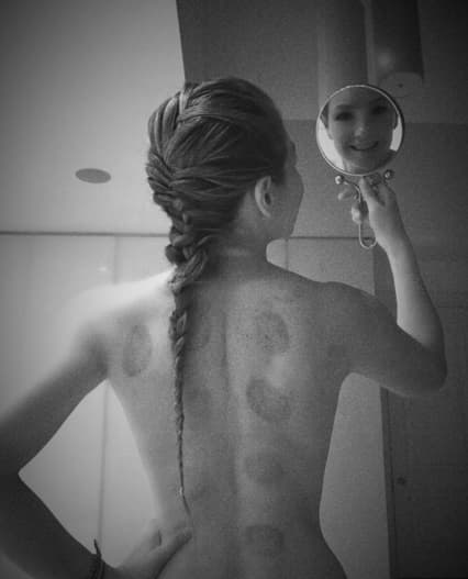 WOW! Al final así quedó su espalda y hasta presumió cinturita de diosa. Según la intéprete de 'Amore Mio' el tratamiento con ventosas sirve para desintoxicar su cuerpo.