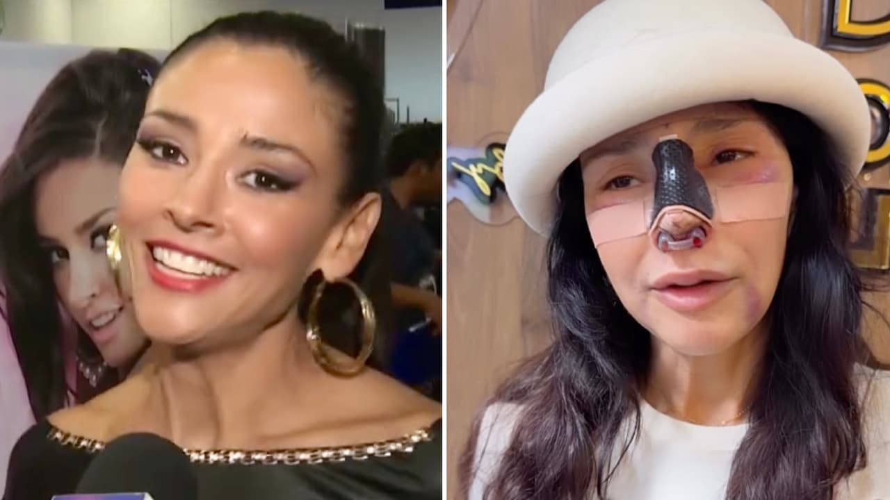 ¡Luce irreconocible! Dorismar muestra los avances en su nariz tras haber sufrido amputación parcial