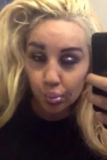 Quien de plano logró un desastre en su rostro fue Amanda Bynes. La famosa pensó que lucía sexy con esos labios deformados y lo presumió en rede sociales.