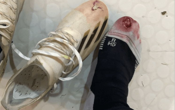 Sebastián Córdova muestra aparatosa herida en dedo del pie