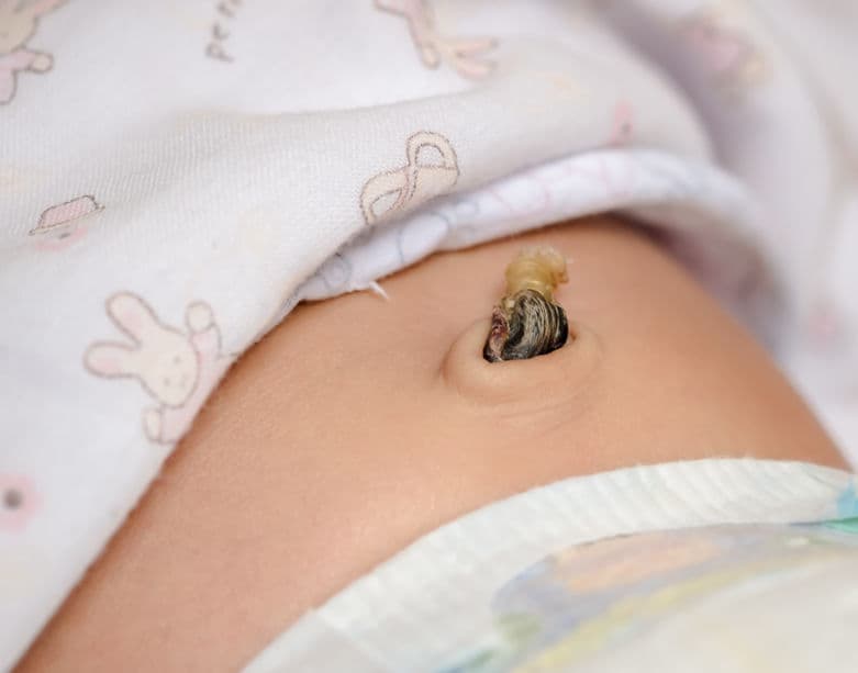 Entonces, lo que debes hacer es mantener el muñón seco exponiéndolo al aire, por lo que al poner un pañal, debes doblar la parte delantera para evitar que lo cubra. También puedes colocar gasas en la zona si no quieres dejarlo al aire.