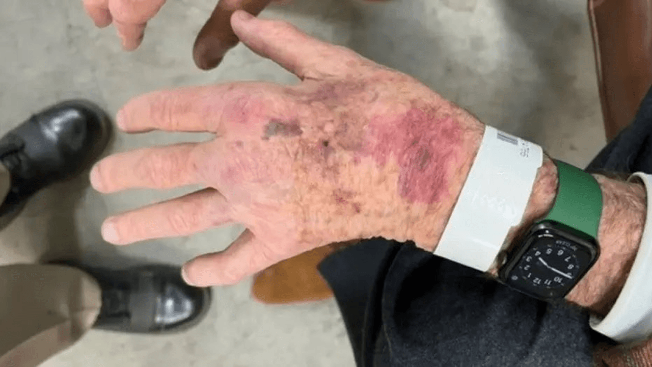 Una imagen de la Patrulla de Caminos de California muestra que Paul Pelosi resultó con algunos golpes tras la colisión.
<br>