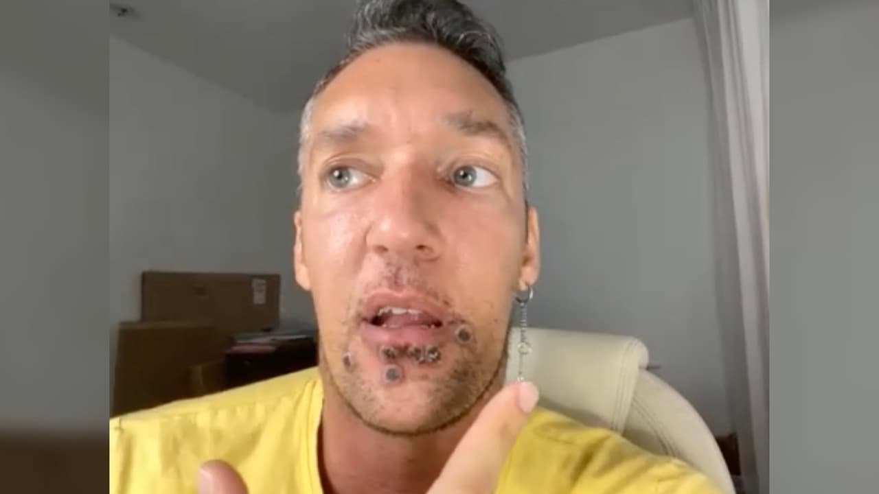 La Organización Mundial de la Salud, justo la misma semana del contagio de este hombre, 
<a href="https://www.univision.com/noticias/salud/oms-viruela-del-mono-emergencia-global" target="_blank">declaró este sábado una "emergencia global de salud"</a> por el aumento de casos de la llamada viruela del mono.
<br>