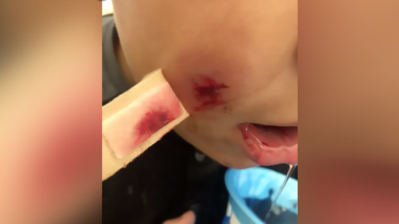 Bala perdida impacta a un niño de 6 años en la cara mientras jugaba en una escuela de Carolina del Norte