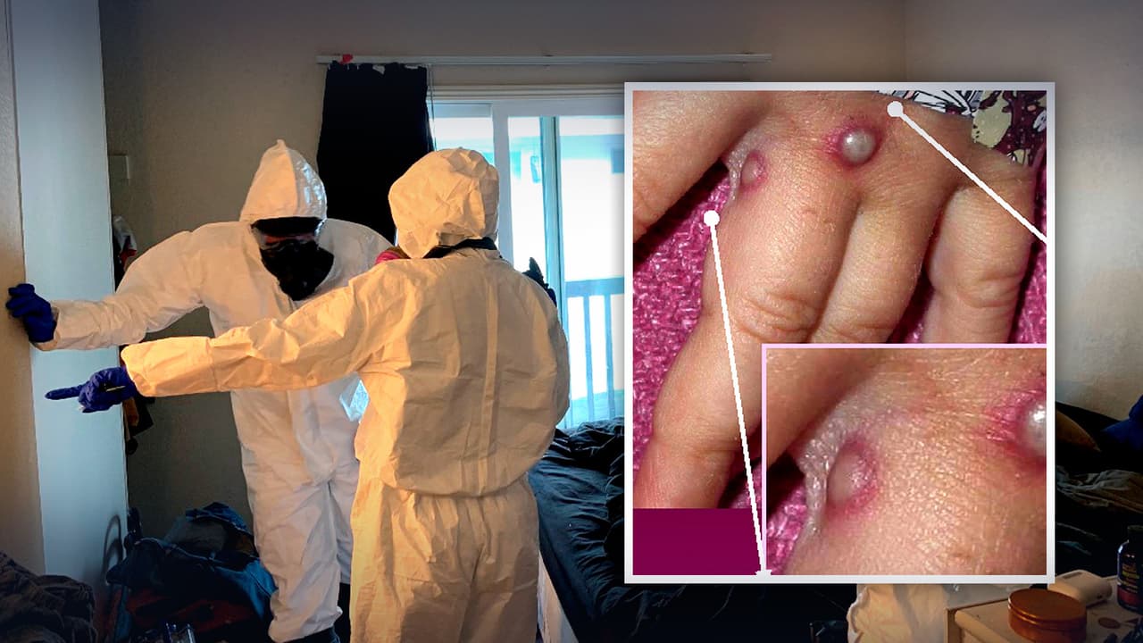 Jefa del gobierno del condado de Harris confirma que un niño pudo haberse contagiado de la viruela del mono