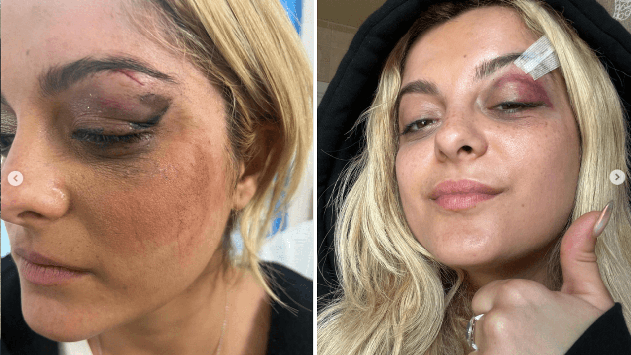 Así luce Bebe Rexha tras el golpe con un celular que recibió en un concierto